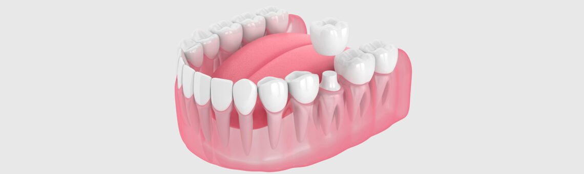 Why and When Do You Need a Dental Crown?